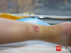 女孩连贴几晚暖宝宝三度烫伤 低温烫伤需警惕[热点]