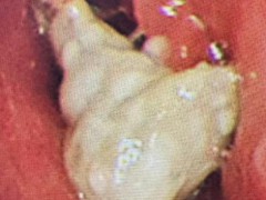 男子假牙卡喉险窒息医生取出 紧急微创手术化险为夷[热点]