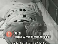50岁大姐在睡梦中粉碎性骨折 癫痫发作引发肌肉强力收缩[热点]