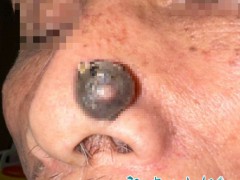 大爷鼻子上长了小疙瘩竟确诊是癌 不疼不痒却暗藏危机[推荐]