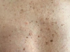 36岁男子因喝偏方皮肤多处癌变 慢性砷中毒警示[推荐]